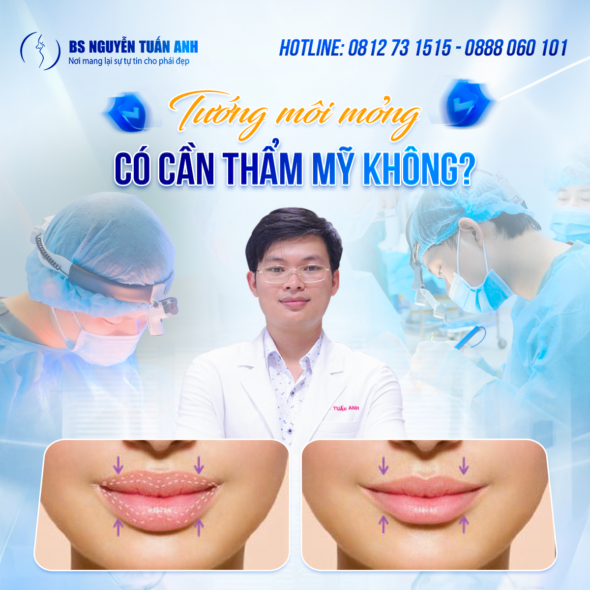 Tướng Môi Mỏng
